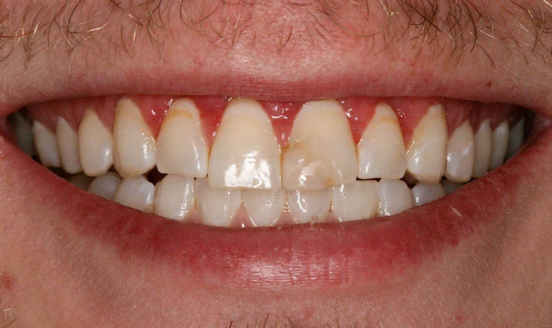 Dental veneers. Before photo.