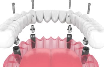 Image of All-On-Four implant supported denture placed with four dental implants into jaw bone.