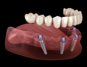 Image of All on Four Dental Implant in our Dental Implant Center. 